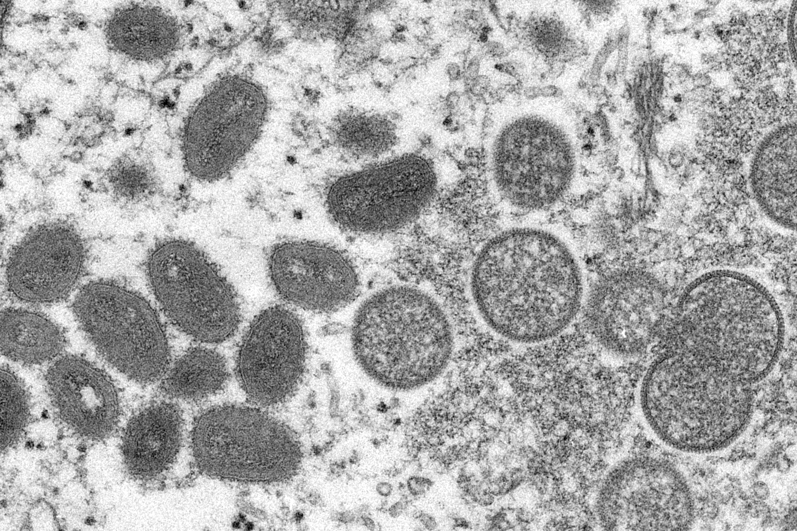 What we know about monkeypox in Massachusetts - Vimarsana News